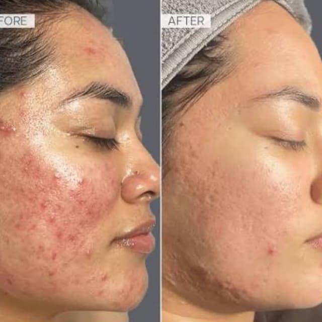 Loba Acne Bootcamp Membership at Loba Beauty Spa in Paterson, NJ
